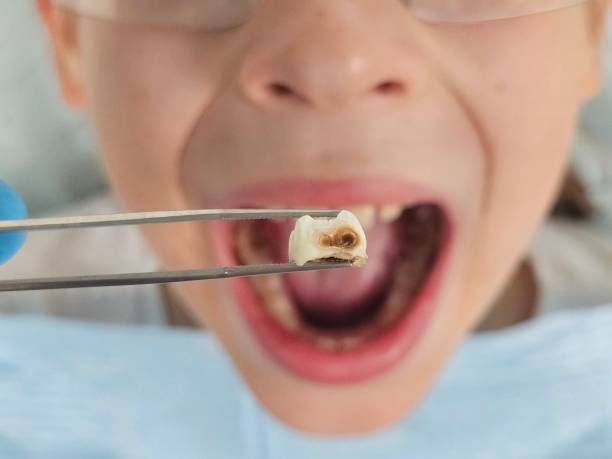 Best Emergency Gum Treatment in Mcadoo, PA